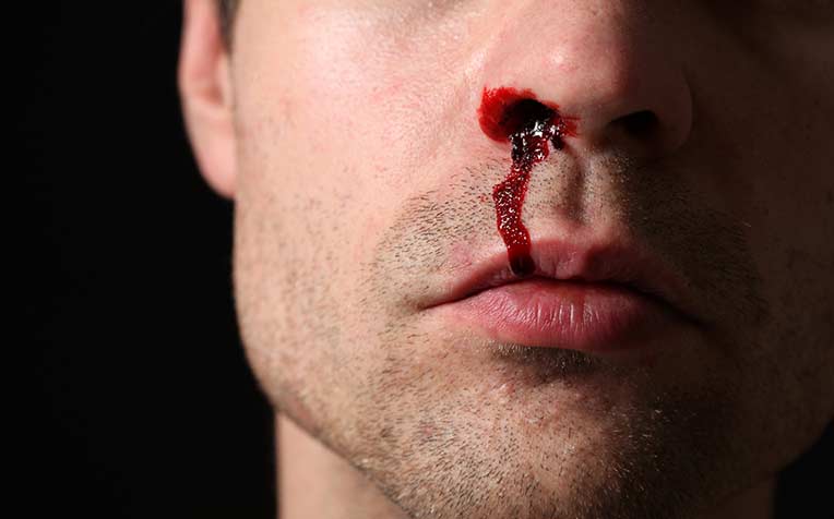 broken-nose-how-to-stop-bleeding-and-what-to-do-next.jpg